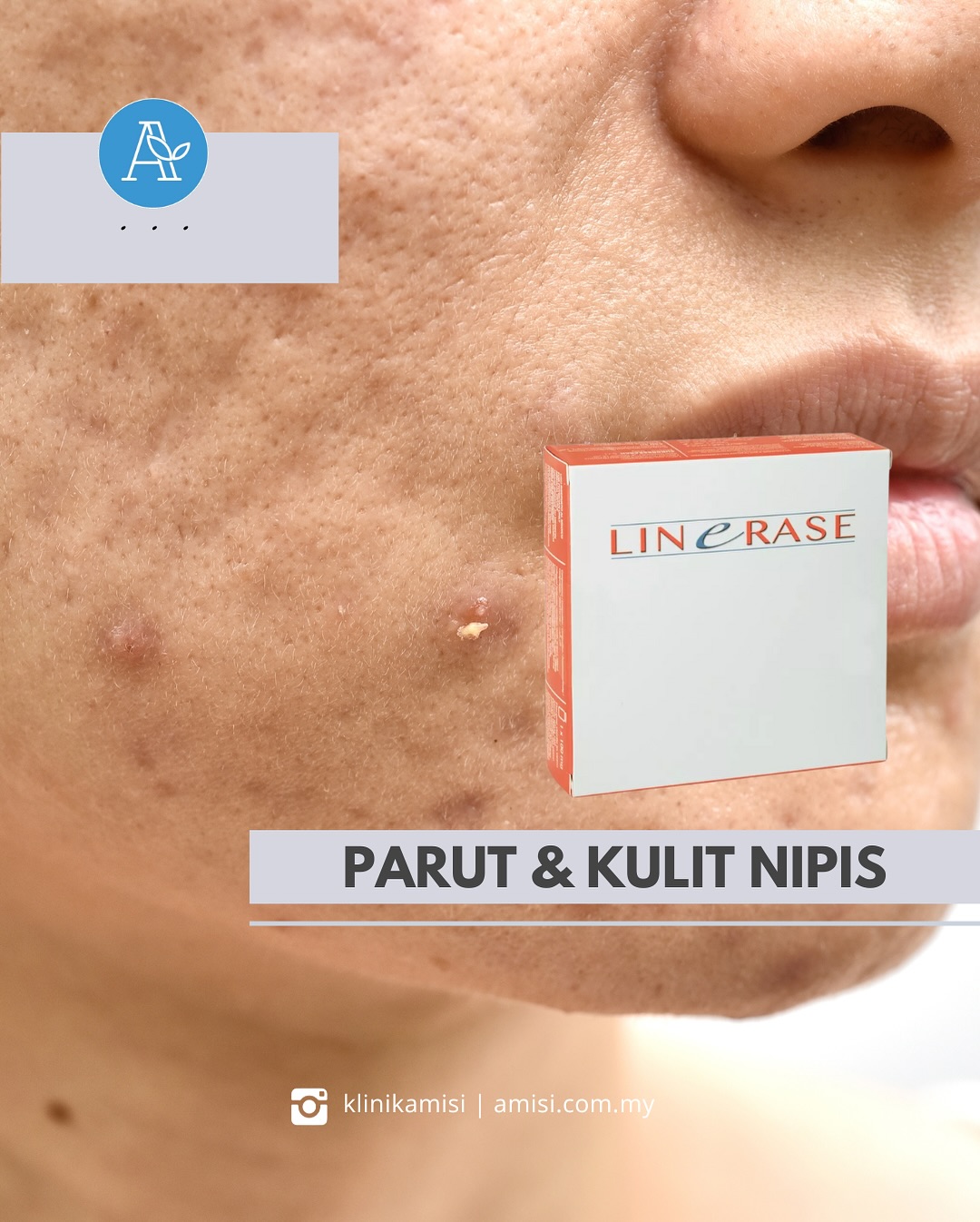 Linerase treatment