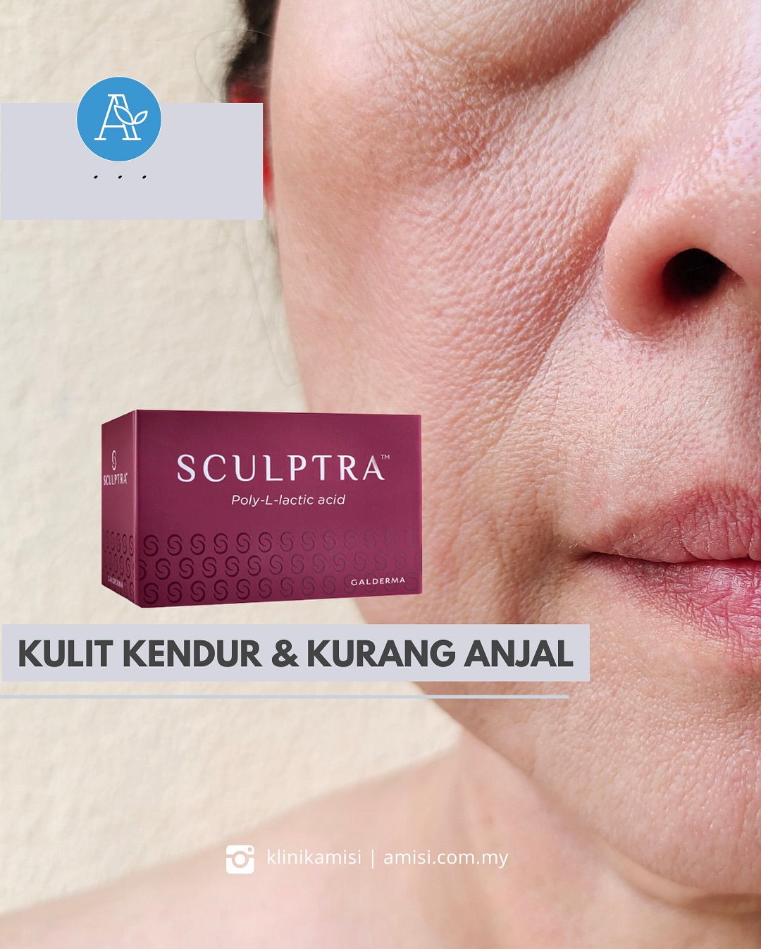 Sculptra treatment